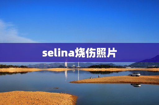 selina烧伤照片