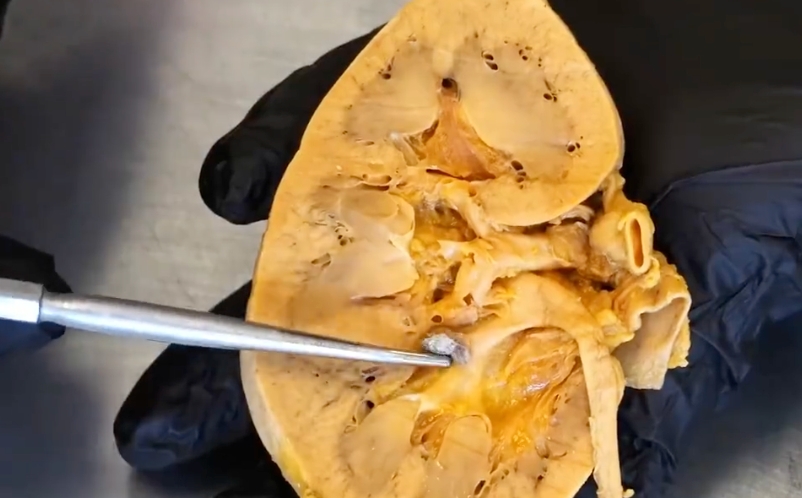 宵夜对肾脏的致命打击：不要再深夜吃饭了！