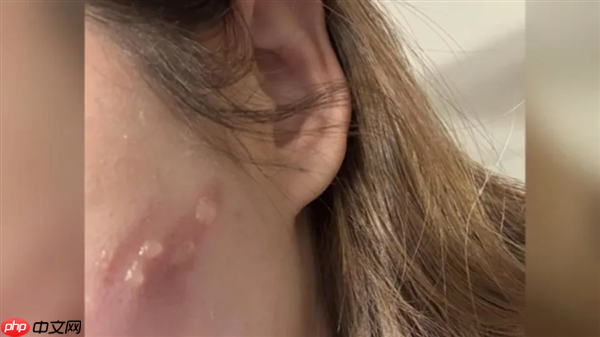 女生玩手机睡着：iPhone贴在脸上直接烫出4颗大水泡！